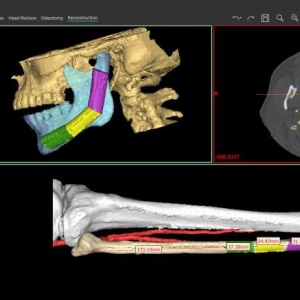 Software pentru planificare chirurgicală cranio-maxilo-facială, chirurgie ortognată – Mimics Enlight CMF (Materialise) - Img 2