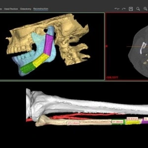 Software pentru planificare chirurgicală cranio-maxilo-facială, chirurgie ortognată – Mimics Enlight CMF (Materialise) - Img 2