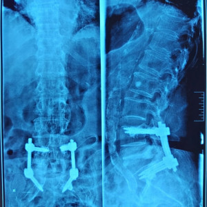 Vesta, Surub din Titan, fenestrat (Osteoporoza,  AP Trauma si Oncologie)