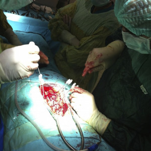 Vesta, Surub din Titan, fenestrat (Osteoporoza,  AP Trauma si Oncologie)