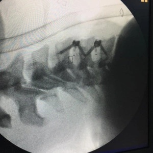 TITANOPEEK STAND ALONE CERVICAL CAGE SYSTEM - Img 5