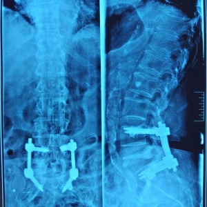 Vesta, Surub din Titan, fenestrat (Osteoporoza,  AP Trauma si Oncologie)