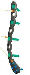 Placa cu extremitate laterala poliaxiala pentru osteointeza fracturii de clavicula