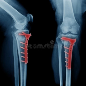 Placa de tibie proximala in T poliaxiala pentru osteosinteza fracturii de tibie Enlife