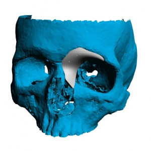 Cranioplasty plate for ENT defects - Img 4