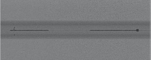 APERIO si APERIO HIBRID, Stent Trombectomie Mecanica ( pentru eliminarea cheagurilor, trombilor din sange)