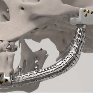 Endoproteză Temporo-Mandibulară TMJ Specifică Pacientului – Soluție 3D Personalizată (Dynajoint™ – BoneEasy)