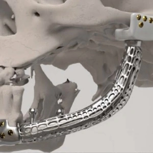Endoproteză Temporo-Mandibulară TMJ Specifică Pacientului – Soluție 3D Personalizată (Dynajoint™ – BoneEasy)