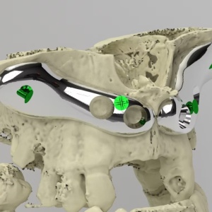 iCMF Ti – Implant Craniomaxilofacial Personalizat din Titan | BoneEasy® - Img 2