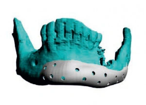 Implant Mandibular Personalizat – Reconstrucție 3D Chirurgie BMF | 3di Germania