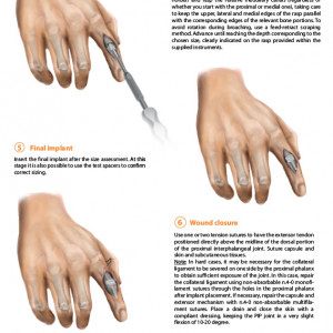 Implant interfalangian PIP din silicon( Chirurgie Plastica, Ortopedie)