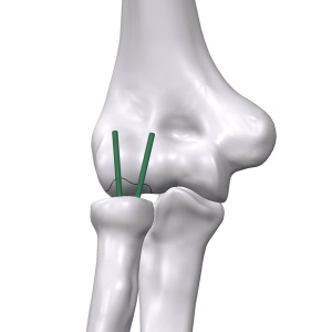 Inion FreedomPin™ – Pin ortopedic bioresorbabil pentru fracturi și osteotomii | Ø1.5–3.2 mm - Img 5