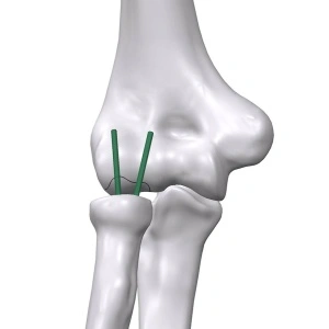 Inion FreedomPin™ – Pin ortopedic bioresorbabil pentru fracturi și osteotomii | Ø1.5–3.2 mm - Img 5