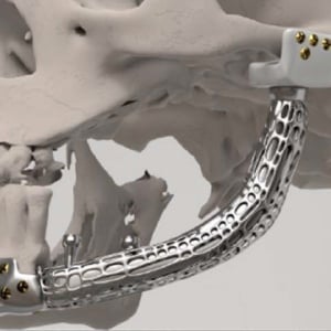 Patient-specific Temporomandibular Joint Endoprosthesis