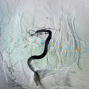 Pictura abstracta: The STROKE ( Accidentul Vascular Cerebral) sau Omul din Copacul Creierului - Img 8
