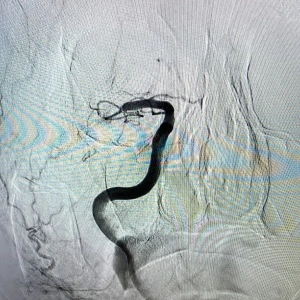 Pictura abstracta: The STROKE ( Accidentul Vascular Cerebral) sau Omul din Copacul Creierului - Img 8