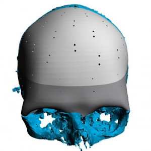 Placa (Cranioplastie), defecte craniene - Img 3