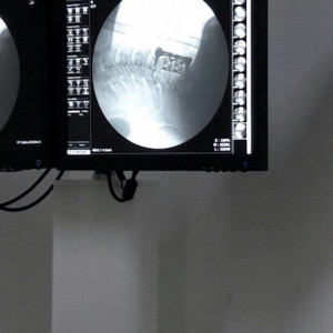SENTINUS CORPECTOMY MESH CAGES - Img 3