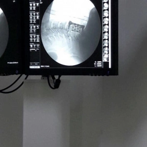 SENTINUS CORPECTOMY MESH CAGES - Img 3