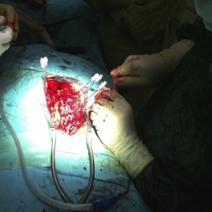 Vesta, Surub din Titan, fenestrat (Osteoporoza,  AP Trauma si Oncologie)