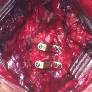 ULTIO LAMINOPLASTY POSTERIOR CERVICAL SPINAL FIXATION SYSTEM - Img 2