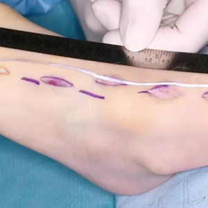 Universal Tendon Spacer U.T.S. – Distanțier Tendinos din Silicon pentru Reconstrucția Tendoanelor Flexorilor și Extensorilor - Img 7