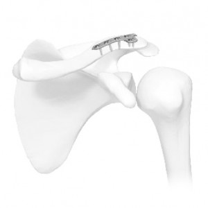 Vortex acromioclavicular clavicle plate