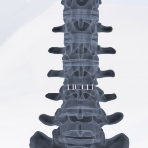 ZELOS – Cage Lombar PLIF din PEEK sau Titan | Fuziune Vertebrală Posterioară - Img 2