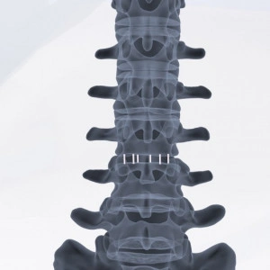 ZELOS – Cage Lombar PLIF din PEEK sau Titan | Fuziune Vertebrală Posterioară - Img 2