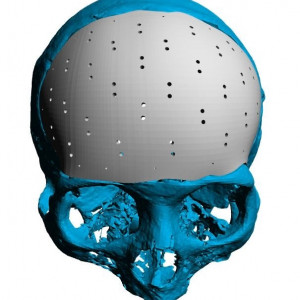 Cranioplasty patient-specific implants - Img 4
