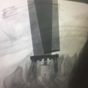 EOS BLADED CERVICAL PEEK CAGE - Img 5