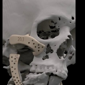 Implant personalizat pentru maxilar, subperiostal – Implantize Compact (Titanium / PEEK) (BoneEasy) - Img 5