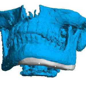 Placă Cranioplastie Personalizată 3D – Implant pentru Defecte BMF | 3di Germania - Img 7