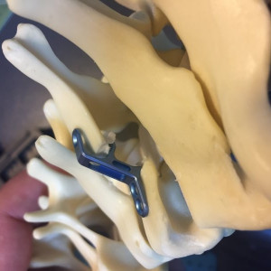 ULTIO Placă Laminoplastie Cervicală | Sistem Fixare Coloană - Img 3