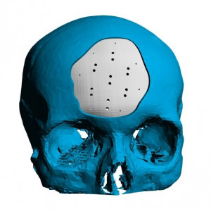 Cranioplasty patient-specific implants