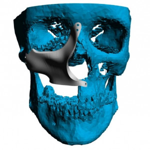 Cranioplasty plate for ENT defects - Img 6