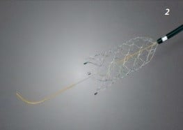 CREDO® Stent Flexible self-expanding nitinol stent for gentle treatment of intracranial stenosis