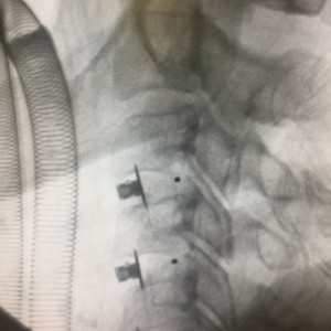 EOS Hybrid – Cage Cervical din PEEK cu Lamă de Fixare | Fuziune ACDF Stabilă - Img 6