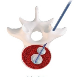 Kit de Kyphoplastie Unipediculară | Reconstrucție Vertebrală Joline | AP Trauma - Img 3