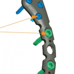 Placa acromioclaviculara poliaxiala pentru osteointeza fracturii de clavicula