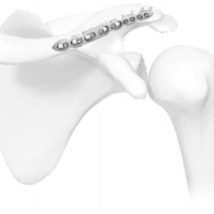 Placă Claviculă în S – Fixare Poliaxială Anatomică | Sistem Vortex
