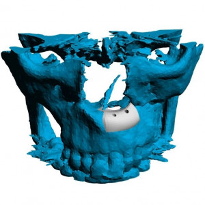Placă Cranioplastie Personalizată 3D – Implant pentru Defecte BMF | 3di Germania - Img 8