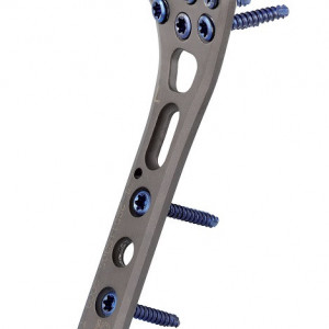 Placa de Radius Distal poliaxiala pentru osteointeza fracturii de radius 