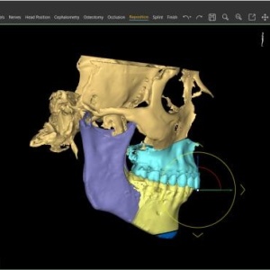 Software pentru planificare chirurgicală cranio-maxilo-facială, chirurgie ortognată – Mimics Enlight CMF (Materialise) - Img 3