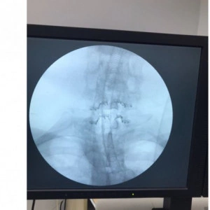 ULTIO LAMINOPLASTY POSTERIOR CERVICAL SPINAL FIXATION SYSTEM - Img 4