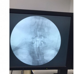 ULTIO Placă Laminoplastie Cervicală | Sistem Fixare Coloană - Img 4