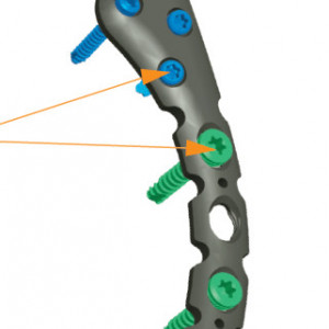 Placa acromioclaviculara poliaxiala pentru osteointeza fracturii de clavicula