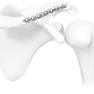 Vortex Clavicle plate (VCL)