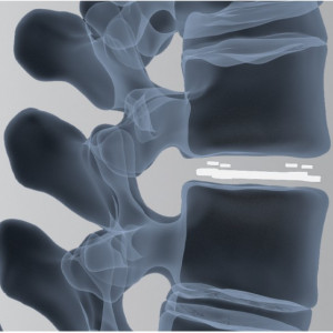 ARIA – Cage Vertebral PLIF Expandabil din PEEK și Titan | Fuziune Lombară Posterioară - Img 2