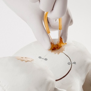 Cranial COVER® – Acoperire Estetică și Sigură pentru Găurile de Trepanație | Neos Surgery - Img 3